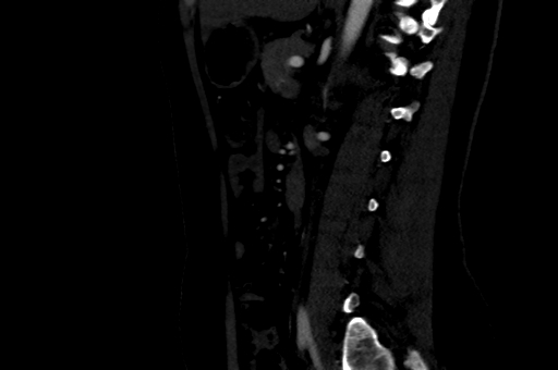 Celiac artery compression syndrome (Radiopaedia 47538-52152 B 64).jpg