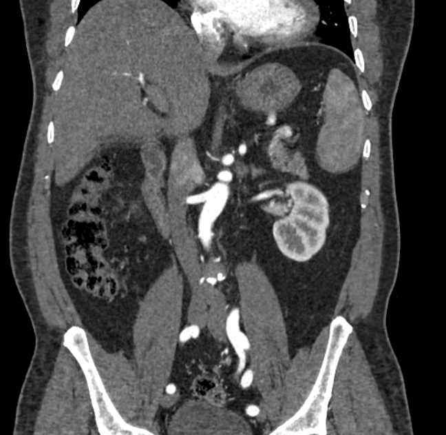 Celiac artery dissection (Radiopaedia 52194-58080 C 62).jpg