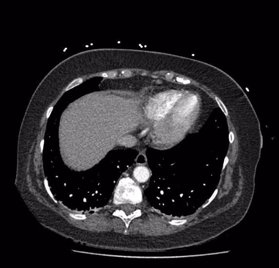 Celiac artery severe stenosis and dissection (Radiopaedia 44128-47842 B 2).jpg