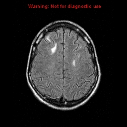 File:Central nervous system vasculitis (Radiopaedia 8410-9235 Axial FLAIR 19).jpg