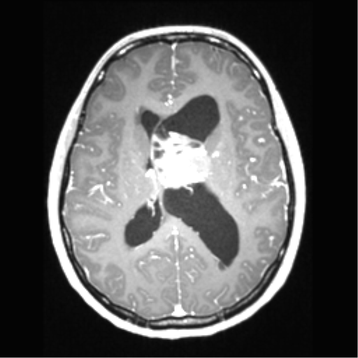 Central neurocytoma (Radiopaedia 37664-39557 Axial T1 C+ 46).png