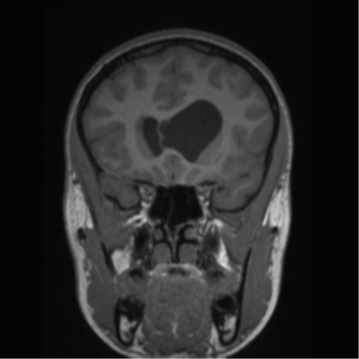 Central neurocytoma (Radiopaedia 37664-39557 Coronal T1 62).png