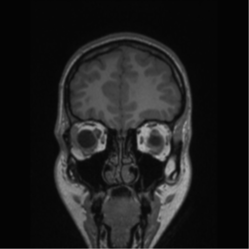 Central neurocytoma (Radiopaedia 37664-39557 Coronal T1 74).png