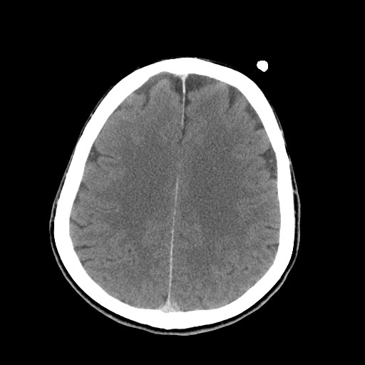File:Central neurocytoma (Radiopaedia 68725-78432 Axial C+ 65).jpg