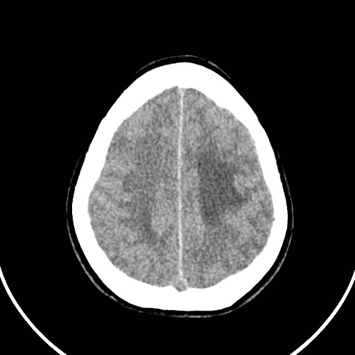 Central neurocytoma (Radiopaedia 84497-99871 Axial non-contrast 42).jpg