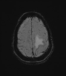 File:Central neurocytoma (Radiopaedia 84497-99872 Axial SWI 59).jpg
