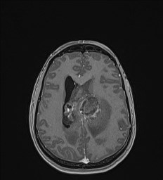 Central neurocytoma (Radiopaedia 84497-99872 Axial T1 C+ 101).jpg