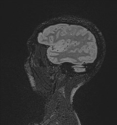 Central neurocytoma (Radiopaedia 84497-99872 Sagittal Flair + Gd 36).jpg