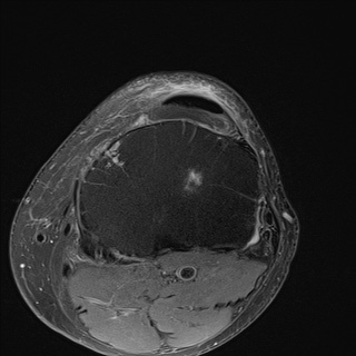 File:Central osteophyte (Radiopaedia 72592-83151 Axial PD fat sat 26).jpg
