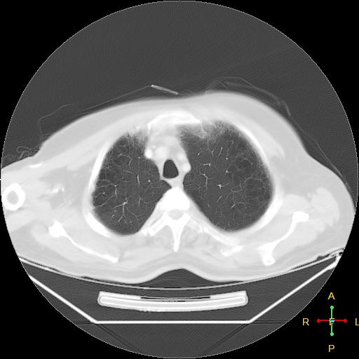 File:Centrilobular emphysema - with superimposed infection (Radiopaedia 24389-24683 lung window 5).jpg
