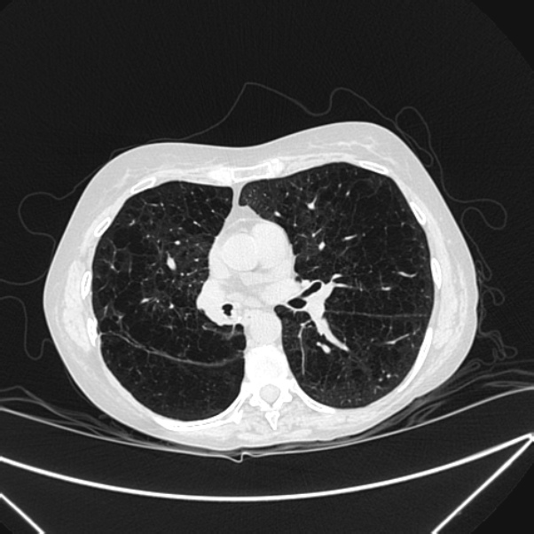 Centrilobular pulmonary emphysema (Radiopaedia 24495-24789 Axial lung window 49).jpg