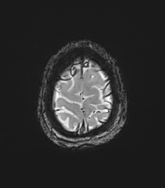 Cerebellar agenesis with hypoplastic pons (pontocerebellar hypoplasia) (Radiopaedia 57224-64138 Axial SWI 83).png