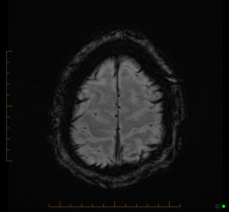 Cerebellar gangliocytoma (Radiopaedia 65377-74422 Axial SWI 54).jpg
