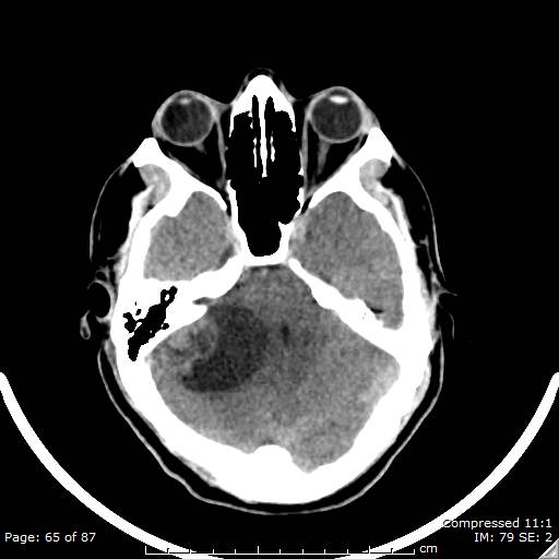 Cerebellar hemangioblastoma (Radiopaedia 52360-58258 Axial non-contrast 65).jpg