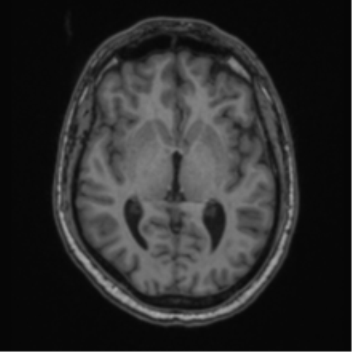 Cerebellar hemangioblastomas and pituitary adenoma (Radiopaedia 85490-101176 Axial T1 37).png