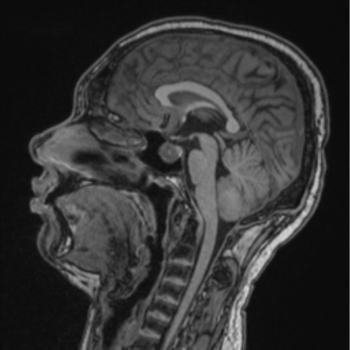 Cerebellar hemangioblastomas and pituitary adenoma (Radiopaedia 85490-101176 Sagittal T1 53).png