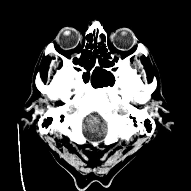 Cerebellar hemorrhage (Radiopaedia 27193-27359 Axial non-contrast 2).jpg