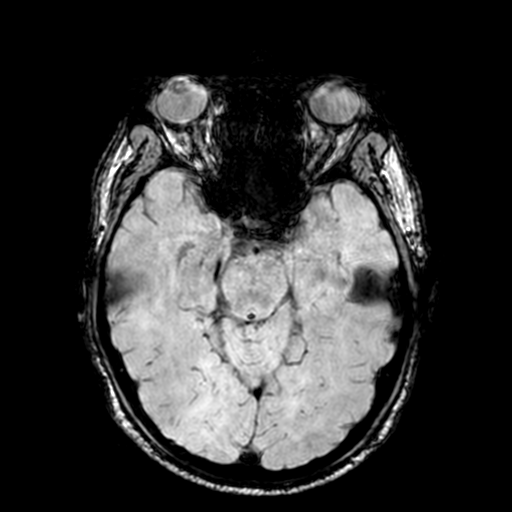 Cerebellar hemorrhage (Radiopaedia 37000-38666 Axial Gradient Echo 32).png
