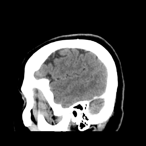 Cerebellar metastasis (cystic appearance) (Radiopaedia 41395-44258 F 11).png