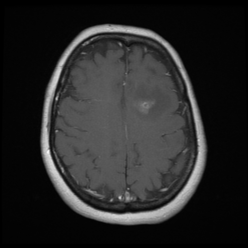 File:Cerebellar metastasis (cystic appearance) (Radiopaedia 41395-44268 Axial T1 C+ 17).png
