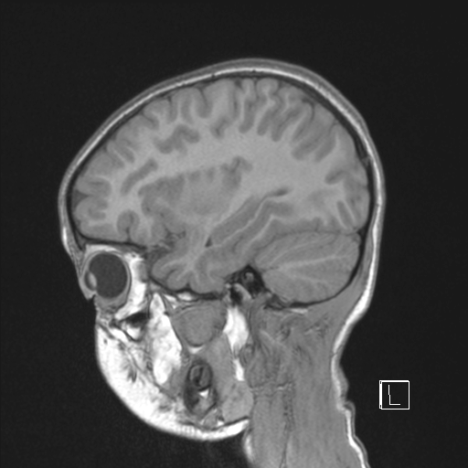 File:Cerebellar stroke (Radiopaedia 32202-33150 Sagittal T1 C+ 38).png