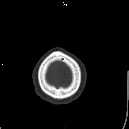 Cerebellopontine angle arachnoid cyst (Radiopaedia 85149-100704 Axial bone window 52).jpg