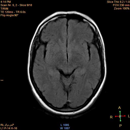 File:Cerebellopontine angle meningioma (Radiopaedia 22488-22525 Axial FLAIR 8).jpg