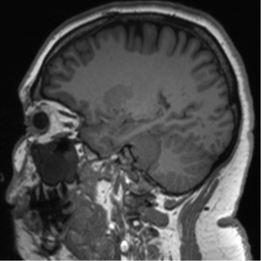 Cerebellopontine angle meningioma (Radiopaedia 48434-53348 Sagittal T1 35).png