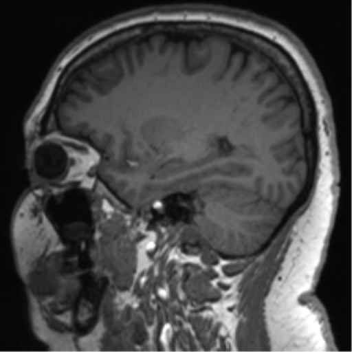 Cerebellopontine angle meningioma (Radiopaedia 48434-53348 Sagittal T1 61).png