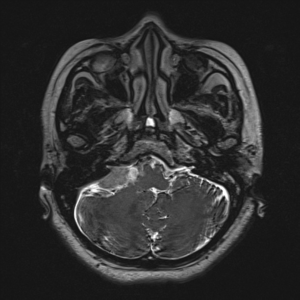 Cerebellopontine angle meningioma (Radiopaedia 53561-59591 Axial 3D volume T2 43).jpg