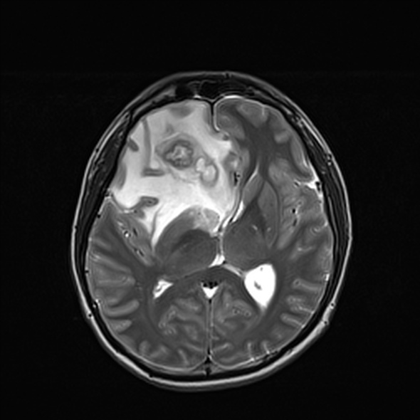 Cerebral abscess (Radiopaedia 24212-24478 Axial T2 33).jpg