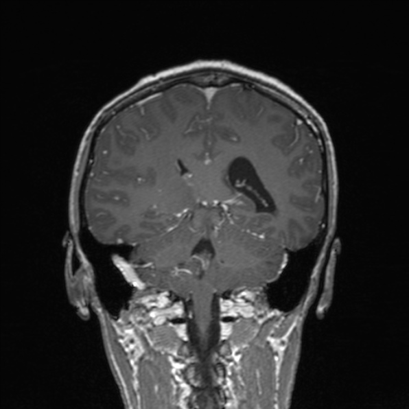 Cerebral abscess (Radiopaedia 24212-24478 Coronal T1 C+ 136).jpg