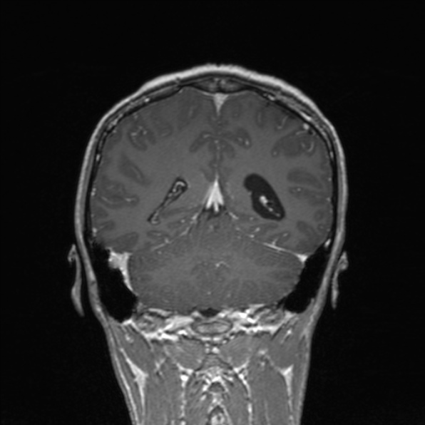 Cerebral abscess (Radiopaedia 24212-24478 Coronal T1 C+ 144).jpg