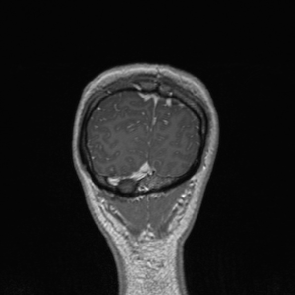 Cerebral abscess (Radiopaedia 24212-24478 Coronal T1 C+ 180).jpg