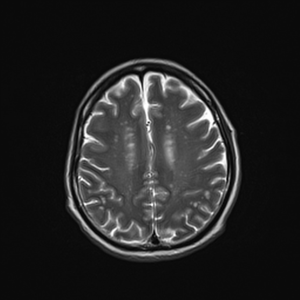 Cerebral abscess (Radiopaedia 26111-26247 Axial T2 43).jpg