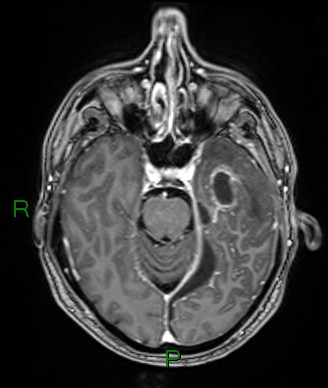 Cerebral abscess and subdural empyema (Radiopaedia 84436-99779 Axial T1 C+ 57).jpg