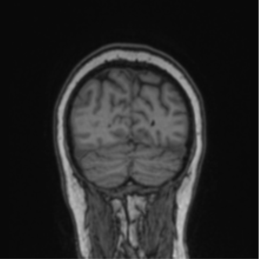 Cerebral abscess from pulmonary arteriovenous malformation (Radiopaedia 86275-102291 Coronal T1 19).png