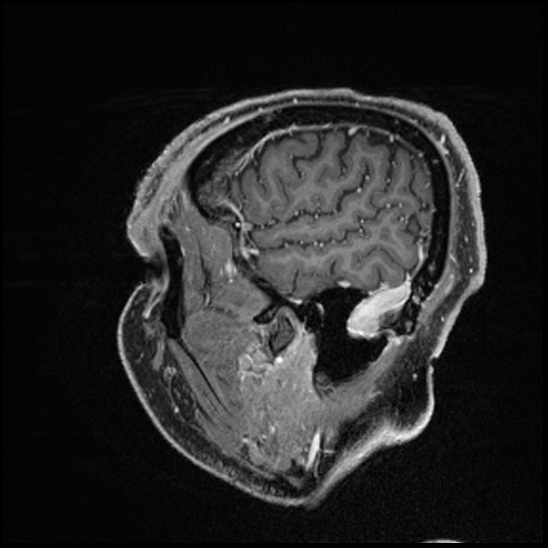 Cerebral abscess with ventriculitis (Radiopaedia 78965-91878 Sagittal T1 C+ 32).jpg