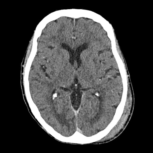 Cerebral amyloid angiopathy-related inflammation (Radiopaedia 74836-85848 Axial non-contrast 32).jpg