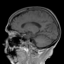 File:Cerebral amyloid angiopathy-related inflammation (Radiopaedia 74836-85849 Sagittal T1 21).jpg