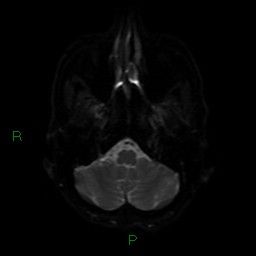 Cerebral amyloid angiopathy (Radiopaedia 77506-89664 Axial DWI 34).jpg