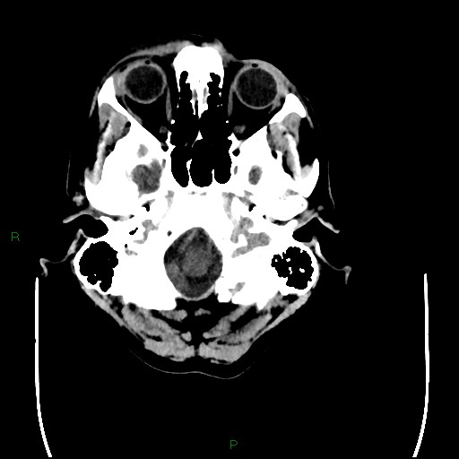Cerebral amyloid angiopathy (Radiopaedia 77506-89665 Axial non-contrast 13).jpg