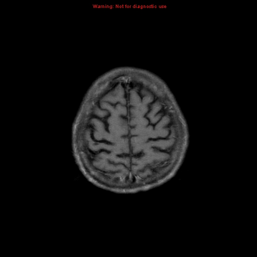File:Cerebral and orbital tuberculomas (Radiopaedia 13308-13311 Axial T1 C+ 18).jpg