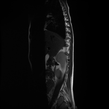 File:Cerebral and spinal tuberculosis (Radiopaedia 90489-107912 Sagittal T2 12).jpg