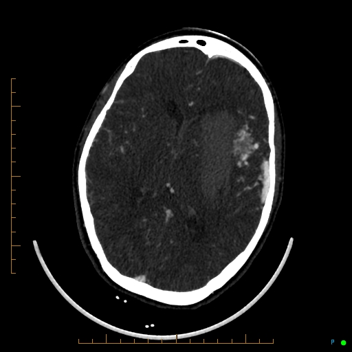 Cerebral arteriovenous malformation (AVM) (Radiopaedia 78162-90706 Axial CTA 152).jpg