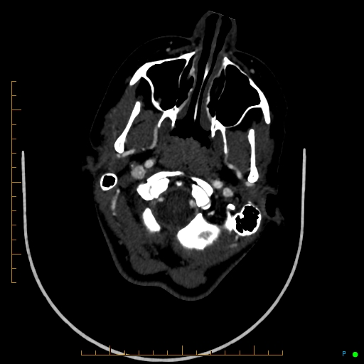 Cerebral arteriovenous malformation (AVM) (Radiopaedia 78162-90706 Axial CTA 44).jpg