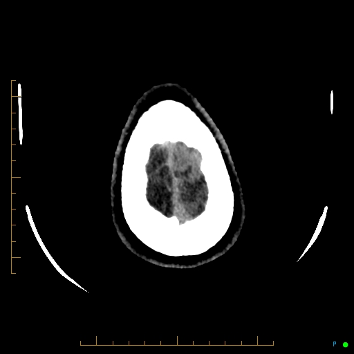 File:Cerebral arteriovenous malformation (AVM) (Radiopaedia 78162-90706 Axial non-contrast 61).jpg