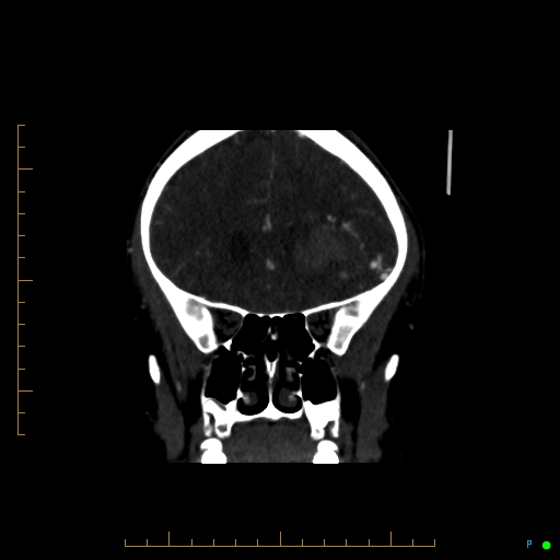 Cerebral arteriovenous malformation (AVM) (Radiopaedia 78162-90706 Coronal CTA 72).jpg