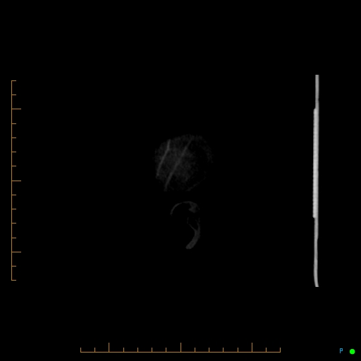 File:Cerebral arteriovenous malformation (AVM) (Radiopaedia 78162-90706 Sagittal CTA 77).jpg