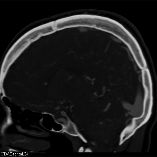File:Cerebral arteriovenous malformation (Radiopaedia 28518-28759 D 31).jpg